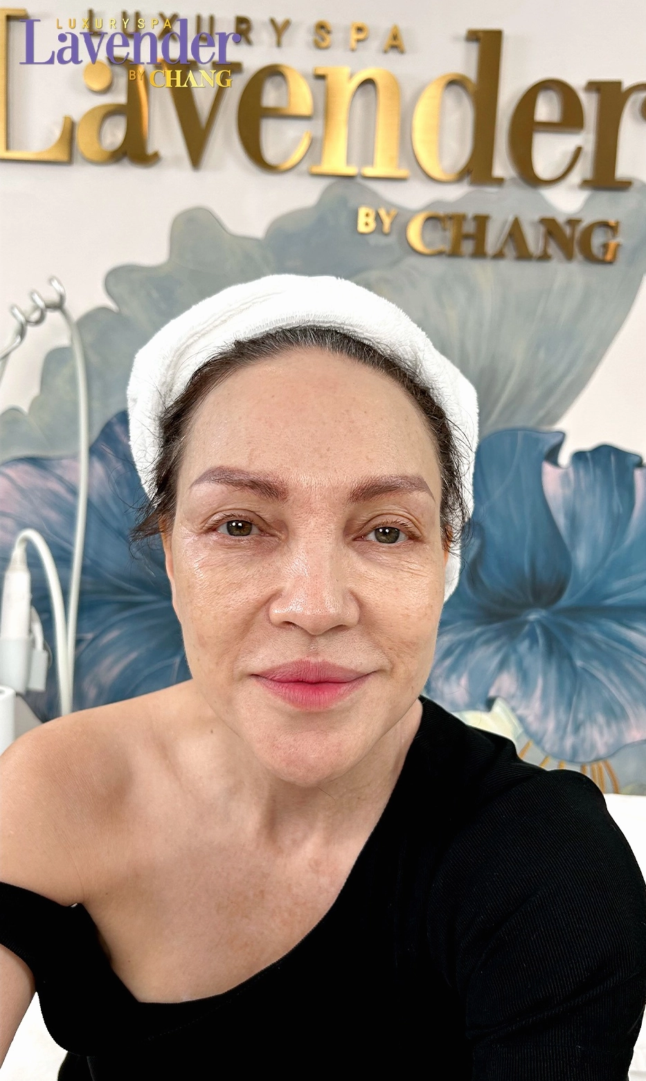 Làn da săn chắc sau khi sử dụng Thermage