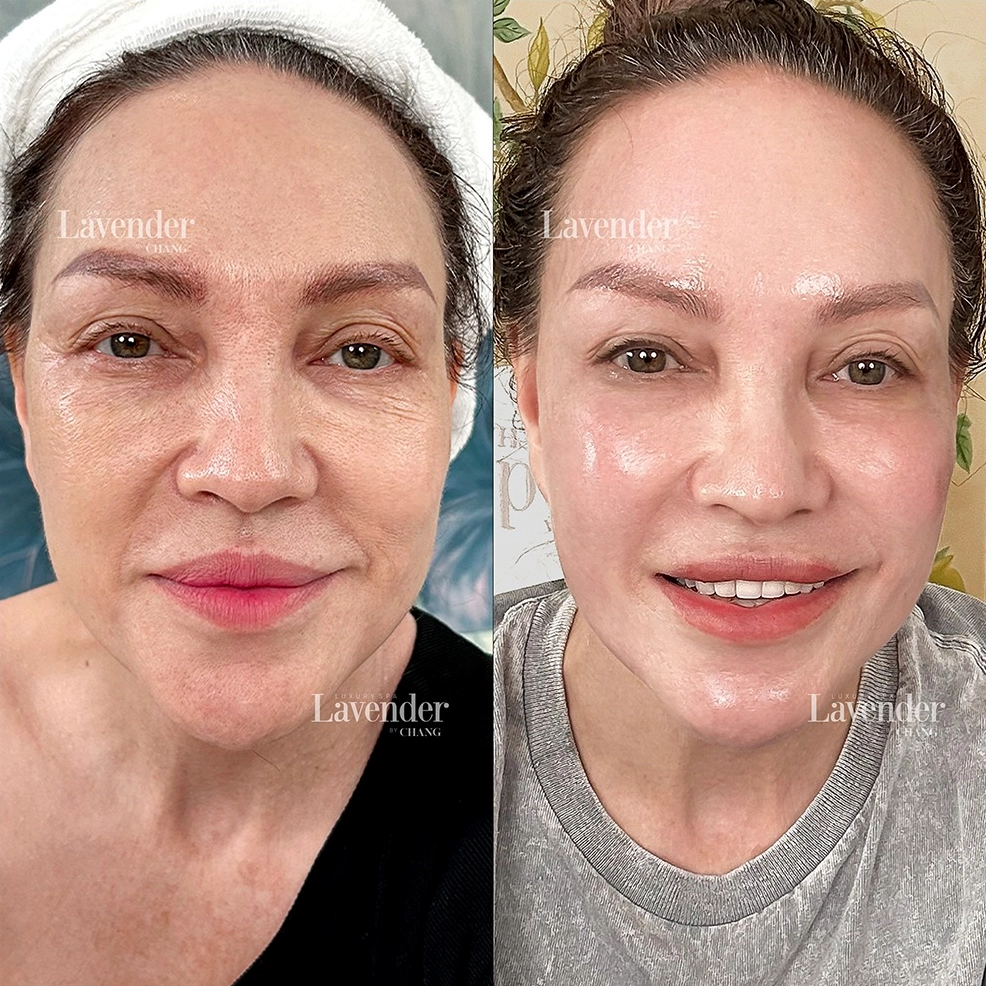 Thermage cho làn da săn chắc hơn