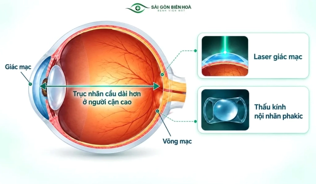 Đánh giá mắt trước khi phẫu thuật cận thị
