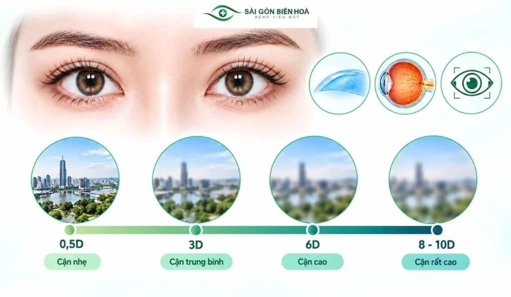 Khả năng phẫu thuật cận thị phụ thuộc nhiều yếu tố
